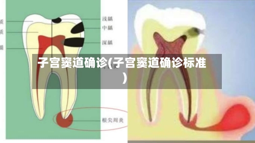 子宫窦道确诊(子宫窦道确诊标准)
