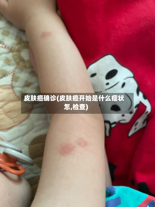 皮肤癌确诊(皮肤癌开始是什么症状怎,检查)-第2张图片