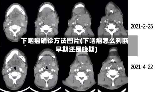 下咽癌确诊方法图片(下咽癌怎么判断早期还是晚期)-第3张图片