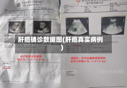 肝癌确诊数据图(肝癌真实病例)-第3张图片