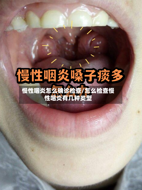 慢性咽炎怎么确诊检查/怎么检查慢性咽炎有几种类型-第3张图片