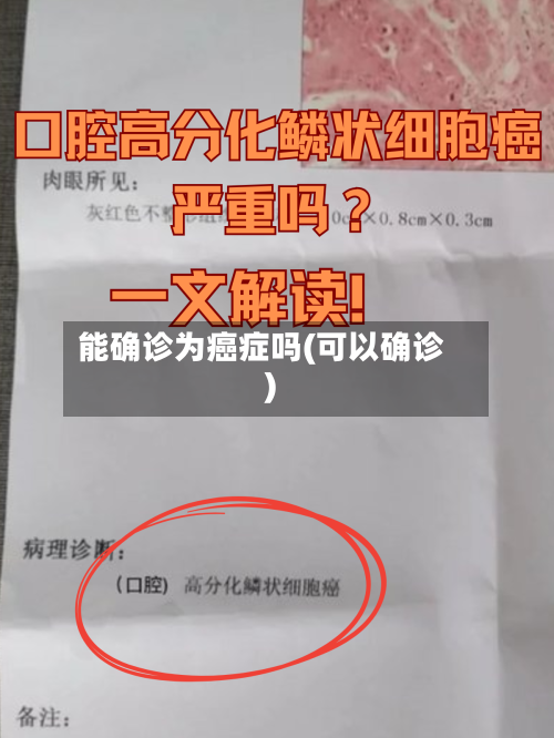 能确诊为癌症吗(可以确诊)
