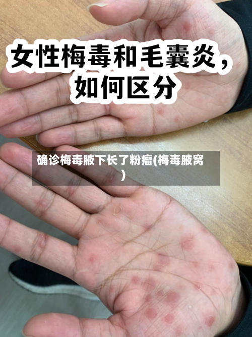 确诊梅毒腋下长了粉瘤(梅毒腋窝)