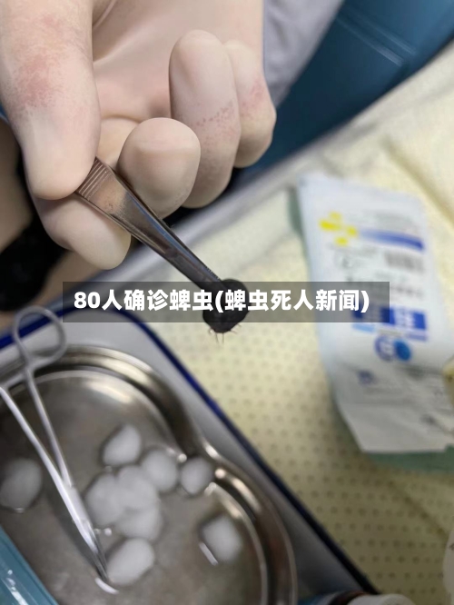 80人确诊蜱虫(蜱虫死人新闻)-第2张图片