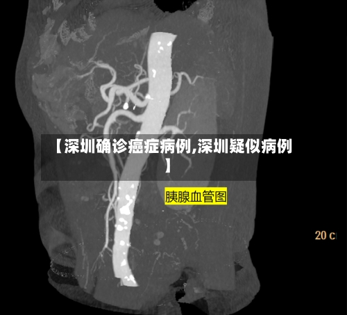 【深圳确诊癌症病例,深圳疑似病例】