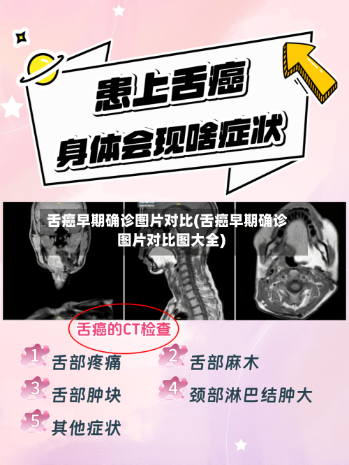 舌癌早期确诊图片对比(舌癌早期确诊图片对比图大全)