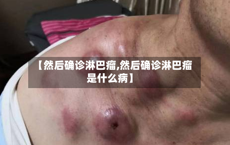 【然后确诊淋巴瘤,然后确诊淋巴瘤是什么病】-第3张图片