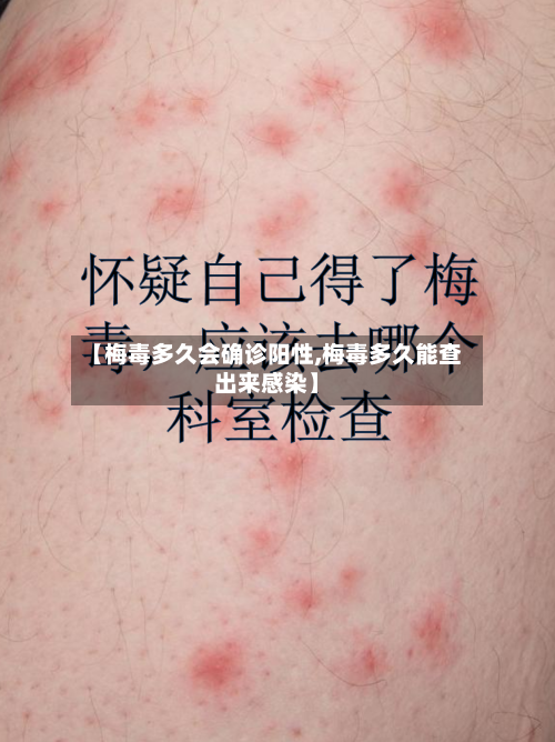 【梅毒多久会确诊阳性,梅毒多久能查出来感染】-第2张图片