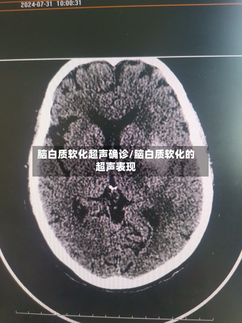 脑白质软化超声确诊/脑白质软化的超声表现