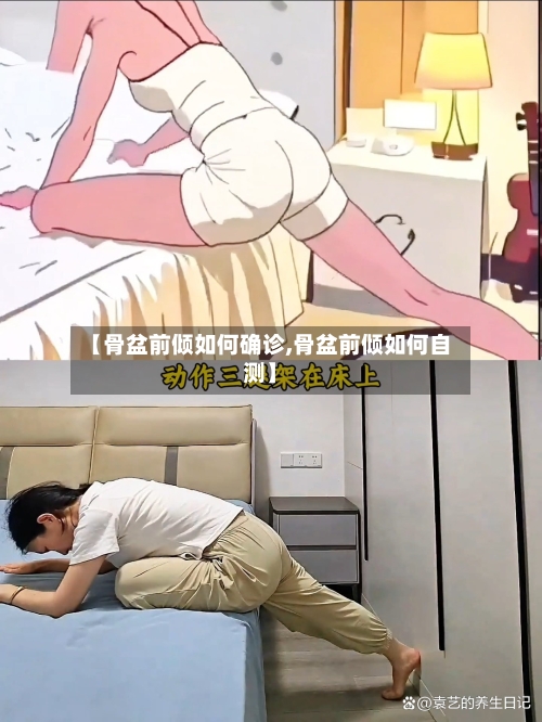 【骨盆前倾如何确诊,骨盆前倾如何自测】