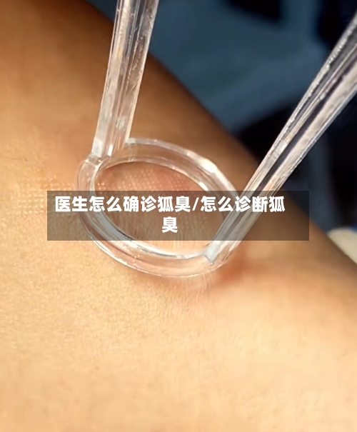 医生怎么确诊狐臭/怎么诊断狐臭