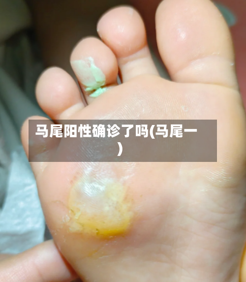 马尾阳性确诊了吗(马尾一)-第2张图片