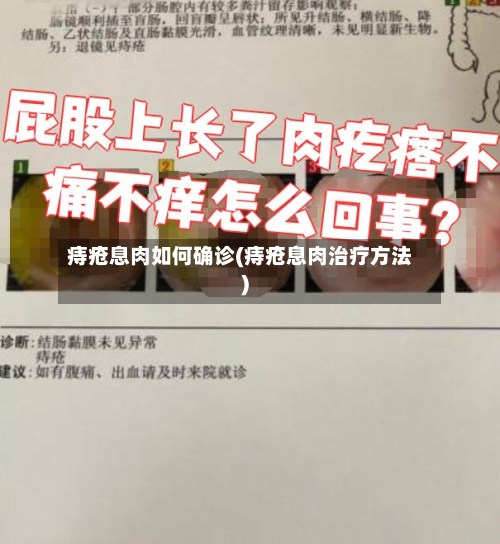 痔疮息肉如何确诊(痔疮息肉治疗方法)-第2张图片