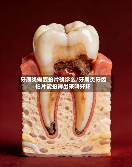 牙周炎需要拍片确诊么/牙周炎牙齿拍片能拍得出来吗好坏