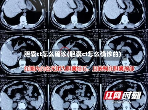 胆囊ct怎么确诊(胆囊ct怎么确诊的)