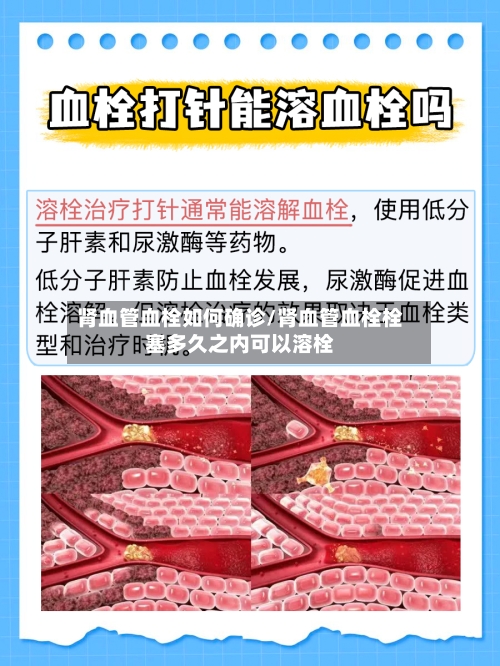 肾血管血栓如何确诊/肾血管血栓栓塞多久之内可以溶栓