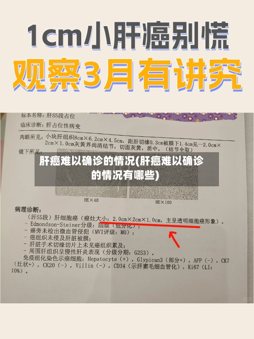 肝癌难以确诊的情况(肝癌难以确诊的情况有哪些)-第3张图片