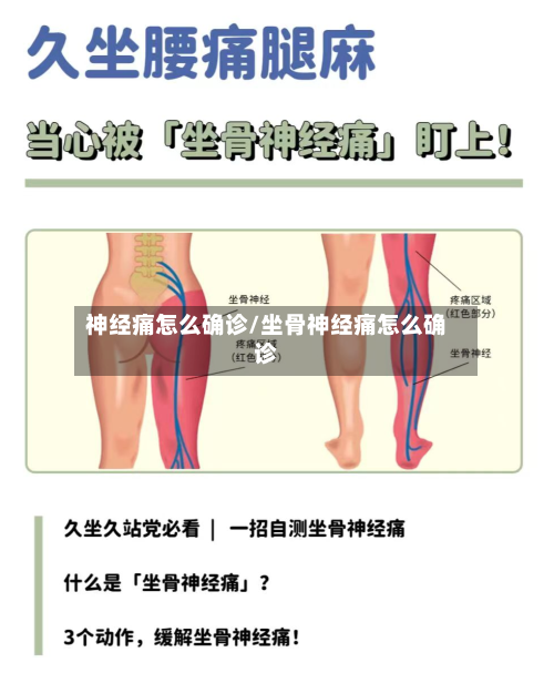 神经痛怎么确诊/坐骨神经痛怎么确诊