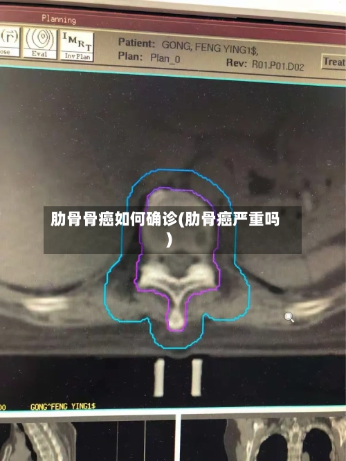 肋骨骨癌如何确诊(肋骨癌严重吗)-第2张图片