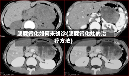 胰腺钙化如何来确诊(胰腺钙化灶的治疗方法)