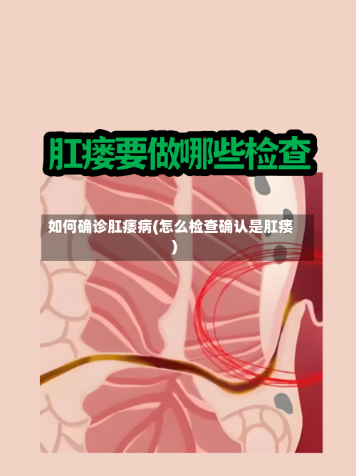 如何确诊肛痿病(怎么检查确认是肛瘘)-第3张图片