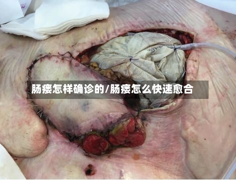 肠瘘怎样确诊的/肠瘘怎么快速愈合-第3张图片