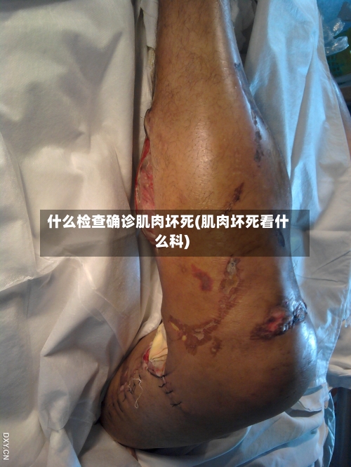 什么检查确诊肌肉坏死(肌肉坏死看什么科)-第2张图片